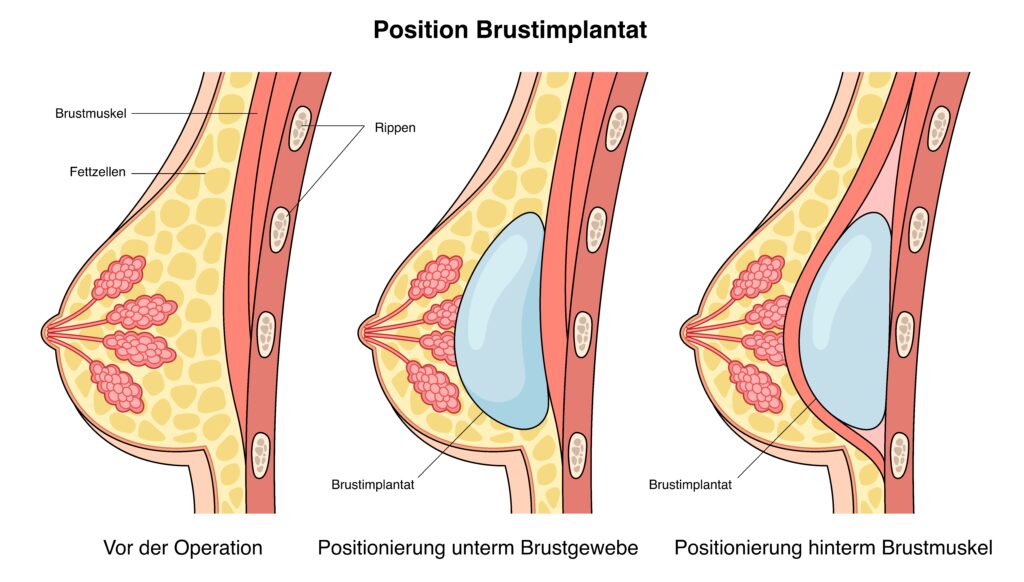 Darstellung über die Positionierung des Brustimplantats in der der weiblichen Brust