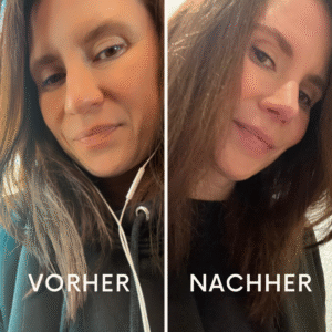 Vorher-Nachher-Bild einer ästhetischen Nasenkorrektur nach 3 Monaten. Erfahrungsbericht mit Heilungsverlauf und OP-Ergebnis